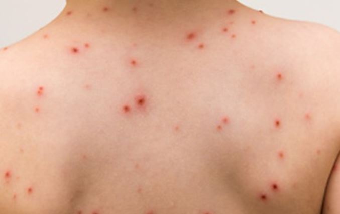 Chickenpox