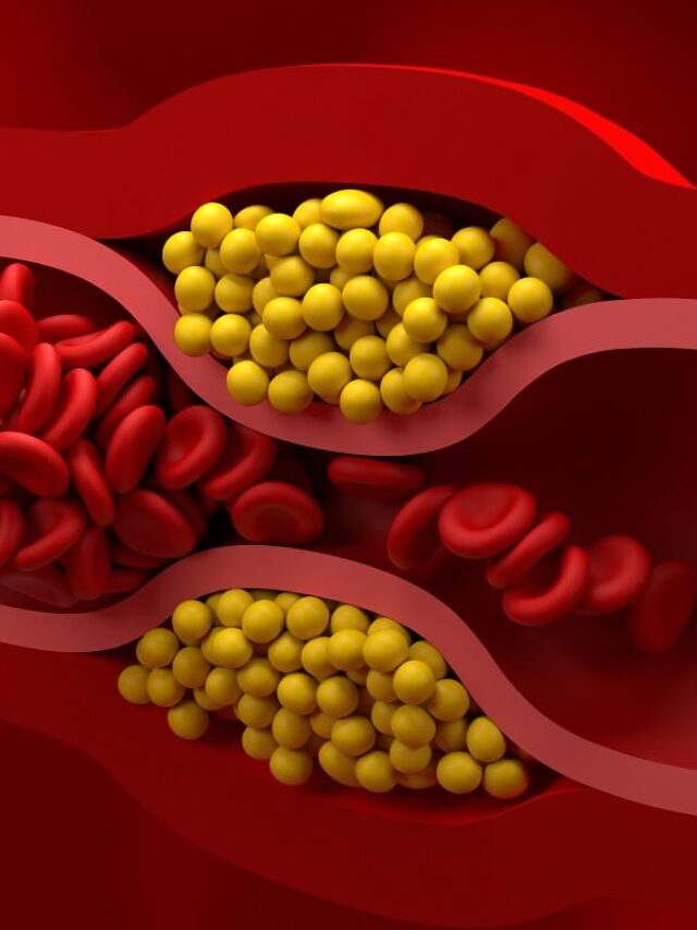 blocked-vessel-in-high-level-of-LDL-bad-cholesterol-lipoprotein