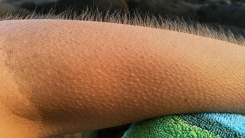 What Causes Goosebumps
