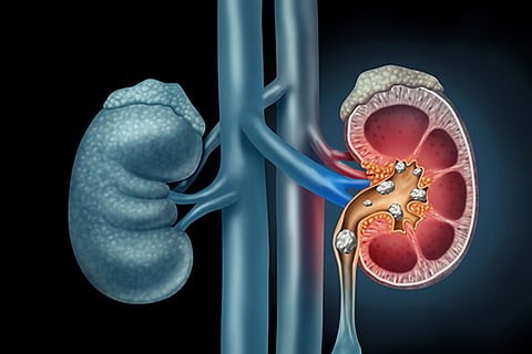 Symptoms of Kidney Stones