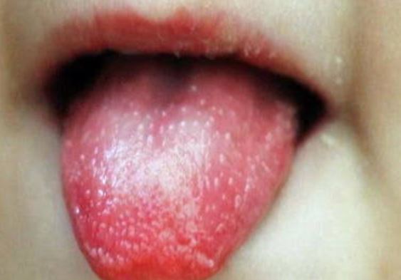 Kawasaki disease death