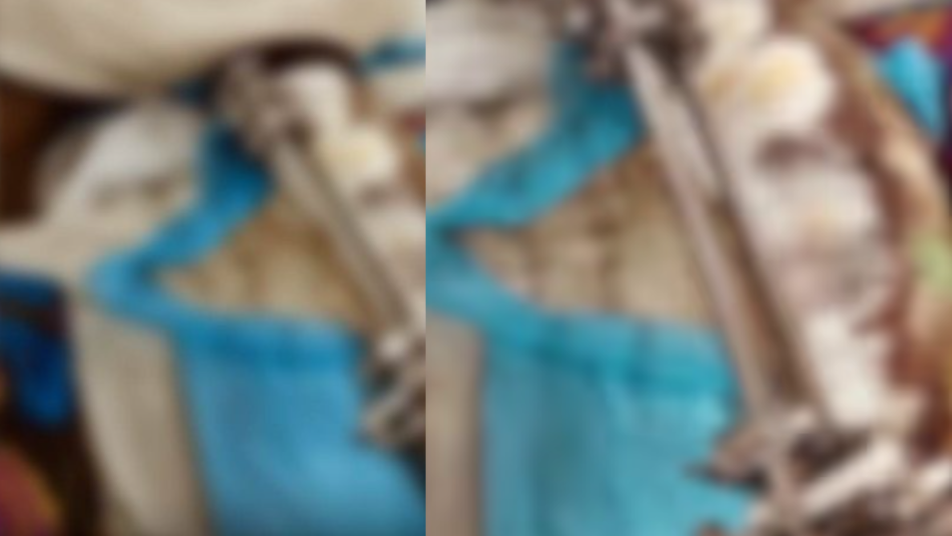 Medical Negligence Surgery Leg Maggots Case