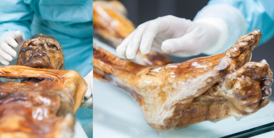 Otzi The Iceman Mummy Living Bacteria