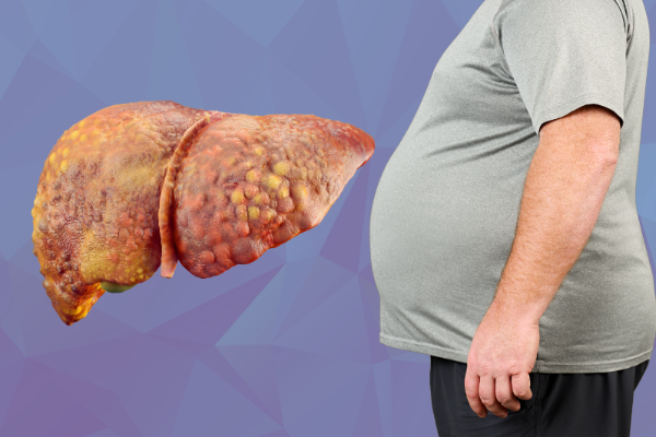Fatty liver disease symptoms