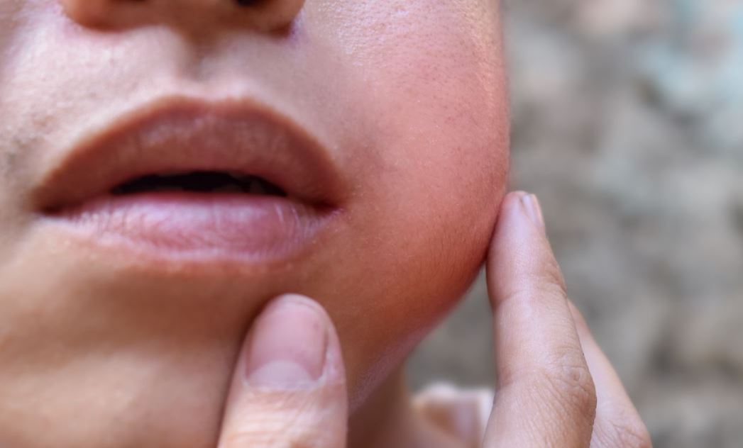 Alappuzha mumps outbreak