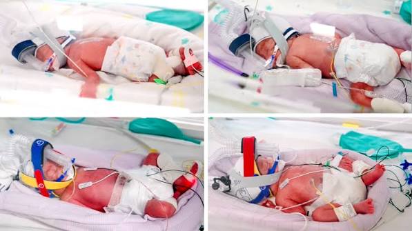 Australia quadruplets birth